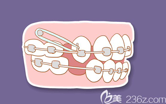 陈聪慧说有些牙合畸形是必须要拔牙的