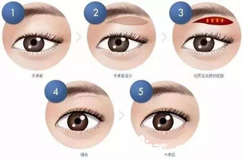 信阳易韩提眉术手术过程