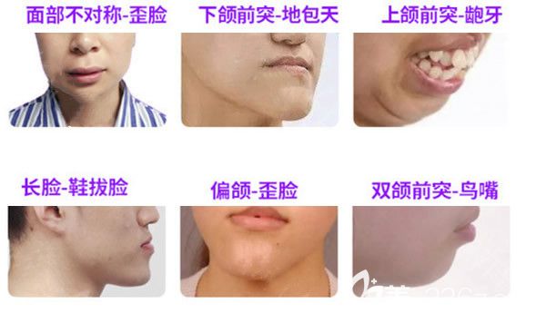 什么人需要做正颌手术 什么人需要做正颌手术
