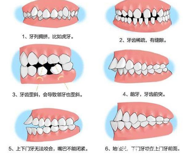哪些牙齿需要矫正 哪些牙齿需要矫正