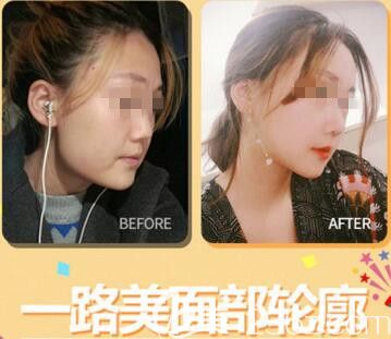 韩国一路美整形外科面部轮廓整形真人案例