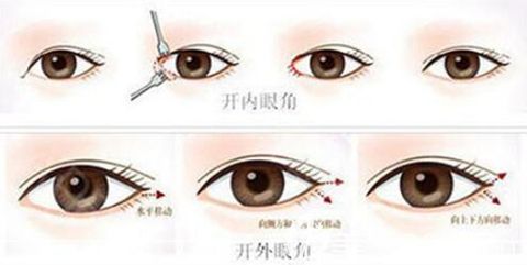 南阳艾美眼综合手术