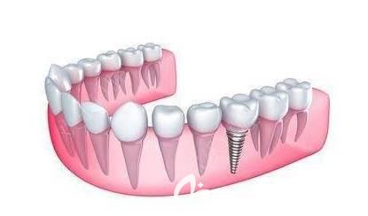 长沙科尔雅口腔谌志远介绍微创种植牙的优势 长沙科尔雅口腔谌志远介绍微创种植牙的优势