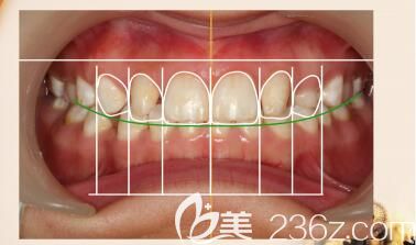 长沙科尔雅口腔陈斌医生解答什么是牙齿美学正畸 长沙科尔雅口腔陈斌医生解答什么是牙齿美学正畸