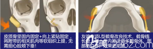 四川友谊医院3D颧骨缩小术技术优势