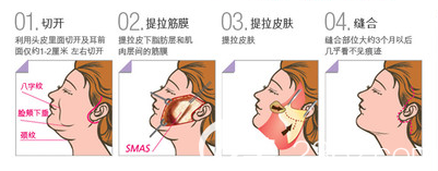 韩国THE整形外科医院面部提升手术示意图