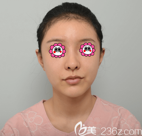 在韩国Profile普罗菲耳做贴发耳矫正前样子 在韩国Profile普罗菲耳做贴发耳矫正前样子