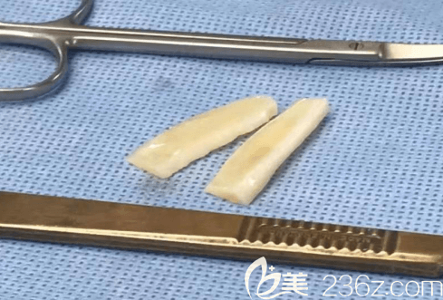 在韩国Profile普罗菲耳做贴发耳矫正使用的材料 在韩国Profile普罗菲耳做贴发耳矫正使用的材料