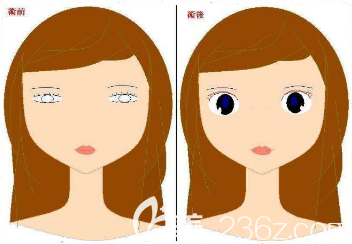 韩国THE CLINIC双眼皮修复特点