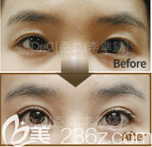 韩国THE CLINIC双眼皮修复真人案例