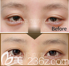 韩国THE CLINIC双眼皮修复真人案例图2