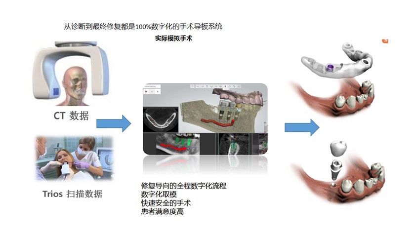 和仁堂的DIOnavi种牙特色技术流程 和仁堂的DIOnavi种牙特色技术流程