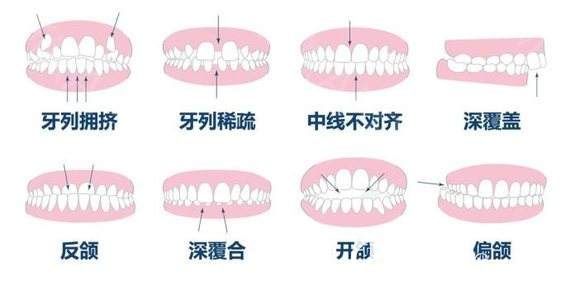 常见的几种需要做牙齿矫正的图片