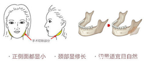 武汉五洲莱美下颌角整形特色与优势
