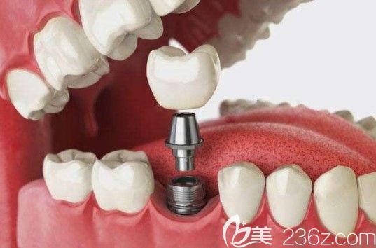 董武申医生解析种植牙的寿命是多久