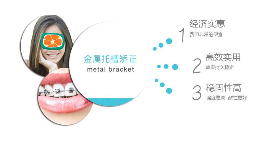 传统金属托槽矫正优势 传统金属托槽矫正优势
