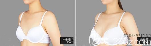 韩国原辰整形外科医院魔滴假体隆胸真人前后效果对比