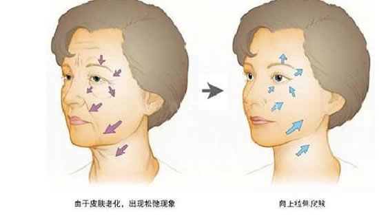 做完小切口除皱术后效果对比图