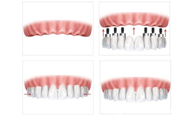 张昌辉医生解析全口种植牙要种植几颗.jpg 张昌辉医生解析全口种植牙要种植几颗.jpg