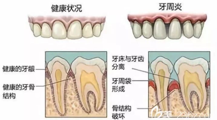 牙周病会导致牙槽骨吸收