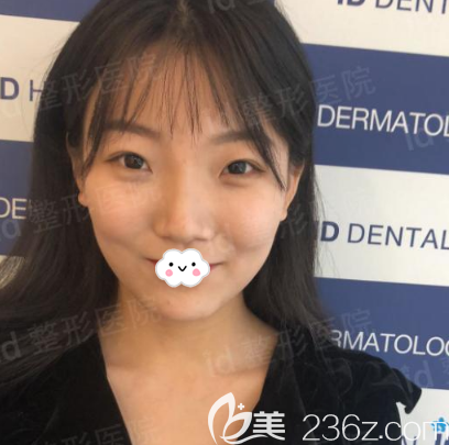 在韩国id整形医院做双眼皮术前照片 在韩国id整形医院做双眼皮术前照片