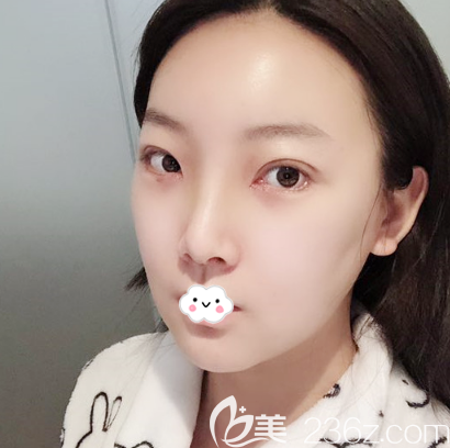 双眼皮开眼角术后10天效果图 双眼皮开眼角术后10天效果图