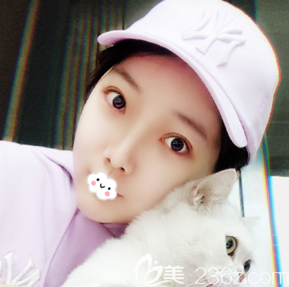 韩国id金一焕院长双眼皮案例术后一个月效果图 韩国id金一焕院长双眼皮案例术后一个月效果图