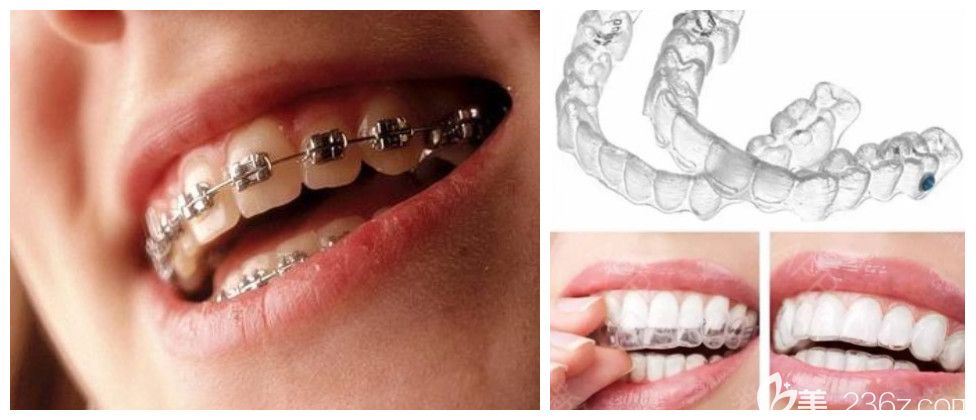 吕靖医生科普隐适美invisalign牙套和传统牙套有什么区别