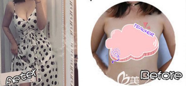 兰州韩美整形樊星医生副乳吸脂效果怎么样