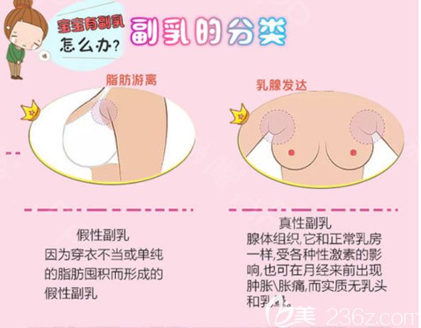 真性副乳假性副乳图片