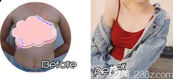 兰州韩美副乳抽脂前后效果对比图