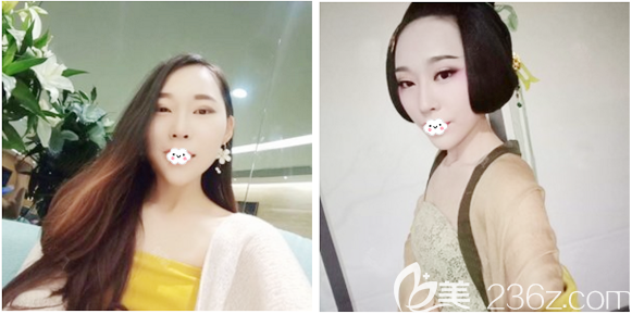 在广州壹加壹做隆胸术前照片 在广州壹加壹做隆胸术前照片