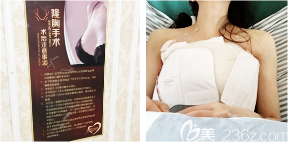 广州壹加壹隆胸术后7天恢复照片 广州壹加壹隆胸术后7天恢复照片