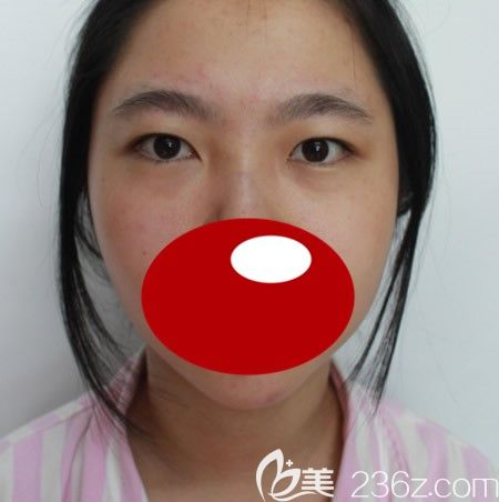 <i data-id='d68550cc-1240-4c94-b9dc-67d5c1c75313' style='display:none;'></i>西华张慧慧为我做双眼皮术前照 <i data-id='d68550cc-1240-4c94-b9dc-67d5c1c75313' style='display:none;'></i>西华张慧慧为我做双眼皮术前照