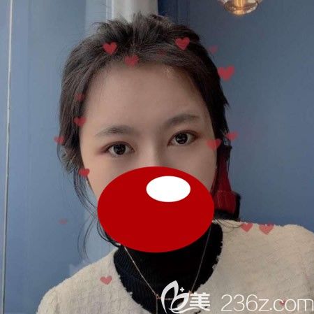 <i data-id='d68550cc-1240-4c94-b9dc-67d5c1c75313' style='display:none;'></i>西华张慧慧为我做双眼皮术后1个月效果 <i data-id='d68550cc-1240-4c94-b9dc-67d5c1c75313' style='display:none;'></i>西华张慧慧为我做双眼皮术后1个月效果