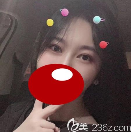 <i data-id='d68550cc-1240-4c94-b9dc-67d5c1c75313' style='display:none;'></i>西华张慧慧为我做双眼皮术后40天美图 <i data-id='d68550cc-1240-4c94-b9dc-67d5c1c75313' style='display:none;'></i>西华张慧慧为我做双眼皮术后40天美图