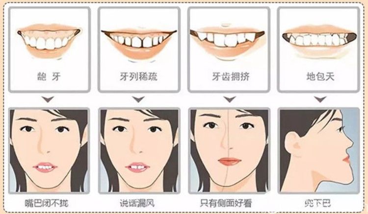 隐形牙套优势有哪些