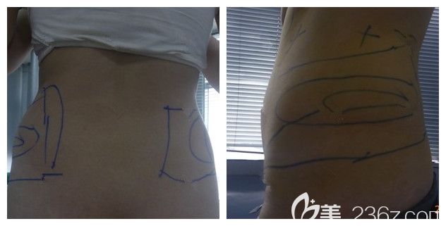 术前面诊连云港华美腰腹部肥胖 术前面诊连云港华美腰腹部肥胖