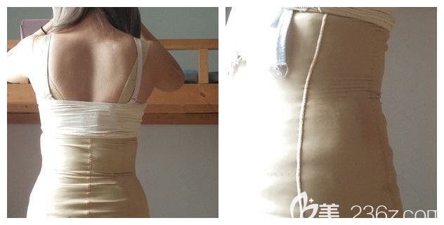 做完多维吸脂腰腹部穿戴塑身衣 做完多维吸脂腰腹部穿戴塑身衣