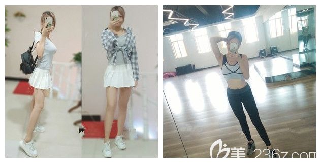 腰腹吸脂多久消肿见到效果?到连云港华美体验过的小仙女说术后一周就要换小码塑身衣了