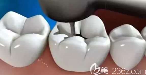 济南圣贝口腔李敏慧主任介绍牙齿嵌体修复的优势