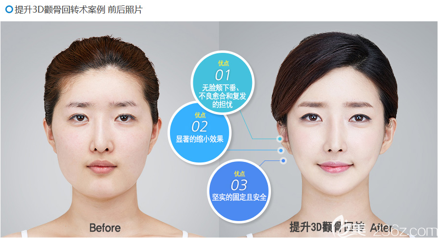 韩国博朗温金兑奎颧骨案例 韩国博朗温金兑奎颧骨案例