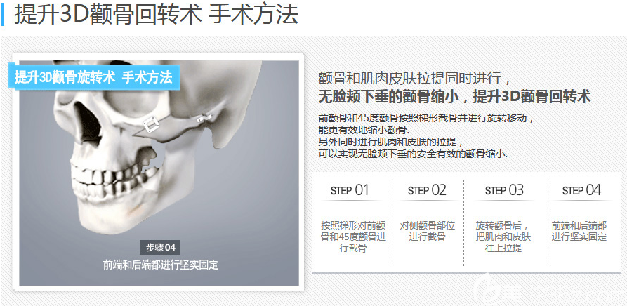 韩国博朗温金兑奎颧骨手术方法示意图 韩国博朗温金兑奎颧骨手术方法示意图