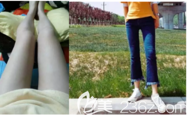梨型身材的我终于在西安叶子整形医院做了大腿环吸手术后恢复的挺好的
