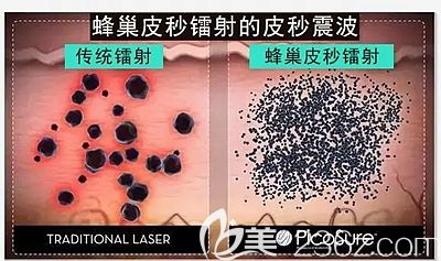 蜂巢皮秒和传统激光的区别