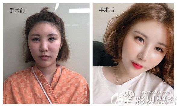 客户做的是鼻部综合手术