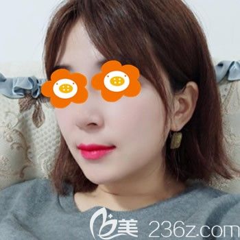 找福州台江李文信隆鼻鼻术后9天图片