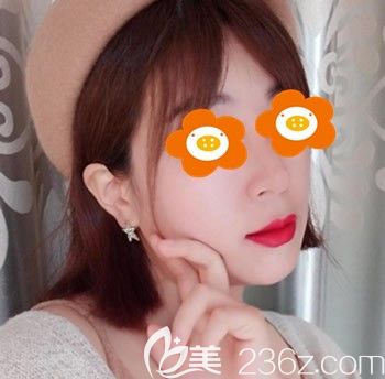 找福州台江李文信做鼻子术后