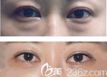 包头叶子整形美容医院眶隔释放去眼袋效果