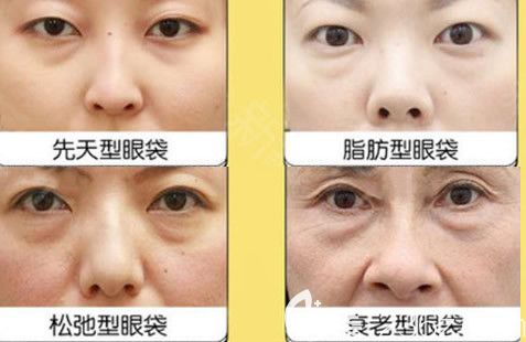 眼袋类型示意图